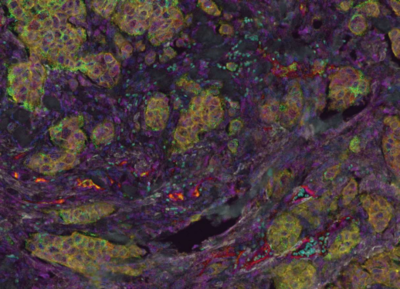 Induction of ADAM10 by Radiation Therapy Drives Fibrosis, Resistance, and Epithelial-to-Mesenchyal Transition in Pancreatic Cancer