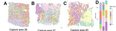 Characterizing intra- and intertumor heterogeneity in ovarian high-grade serous carcinoma subtypes using single-cell and spatial transcriptomics